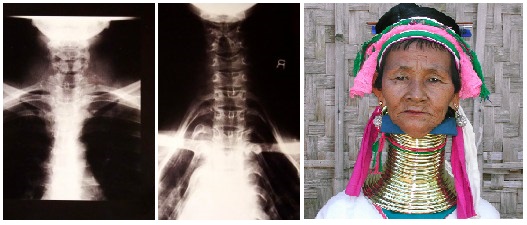 Neck Rings Removal Bone Remodeling – TMD – Occlusion