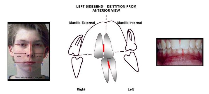 SidebendAnterior