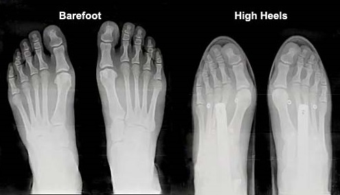 BarefootShodStructure1