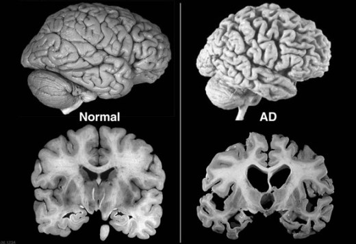alzheimerDiseaseBrain