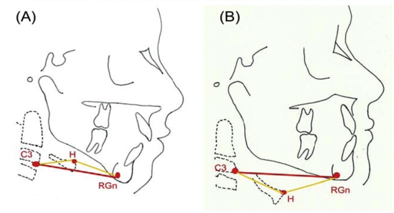 hyoidbone1.jpg