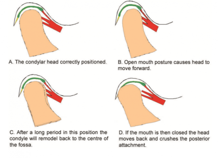 openMouthPosture
