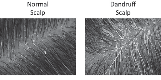 Dandruff.png